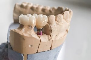 Implante para dientes en 24 horas.