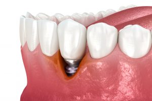 mucositis periimplantaria