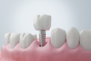 implante dental el mismo día de la extracción