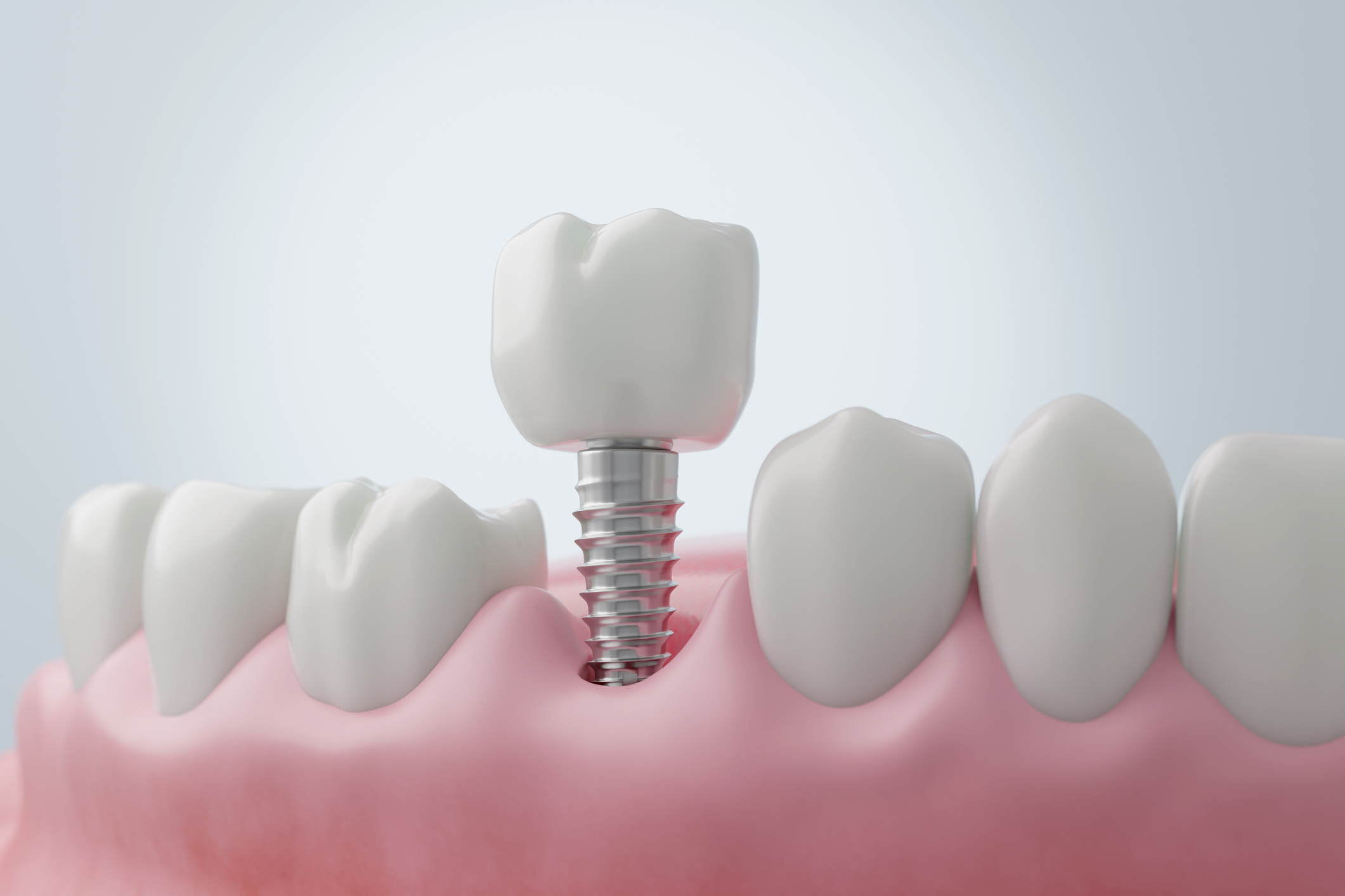 implante dental el mismo día de la extracción